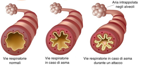 Effetti dell'asma sulle vie respiratorie