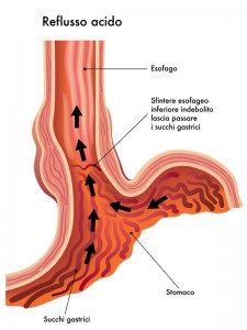 Meccanismo del reflusso gastroesofageo