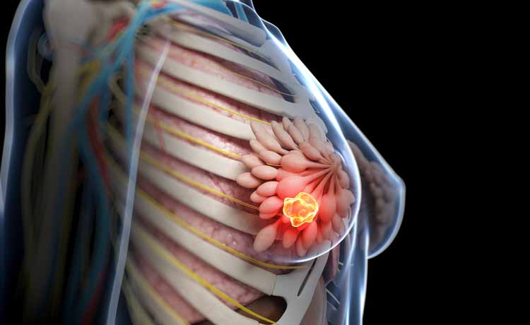 Chemioterapia per il tumore al seno, è davvero efficace?